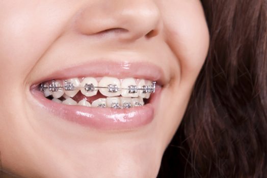 8 Tips for Your First Week of Braces