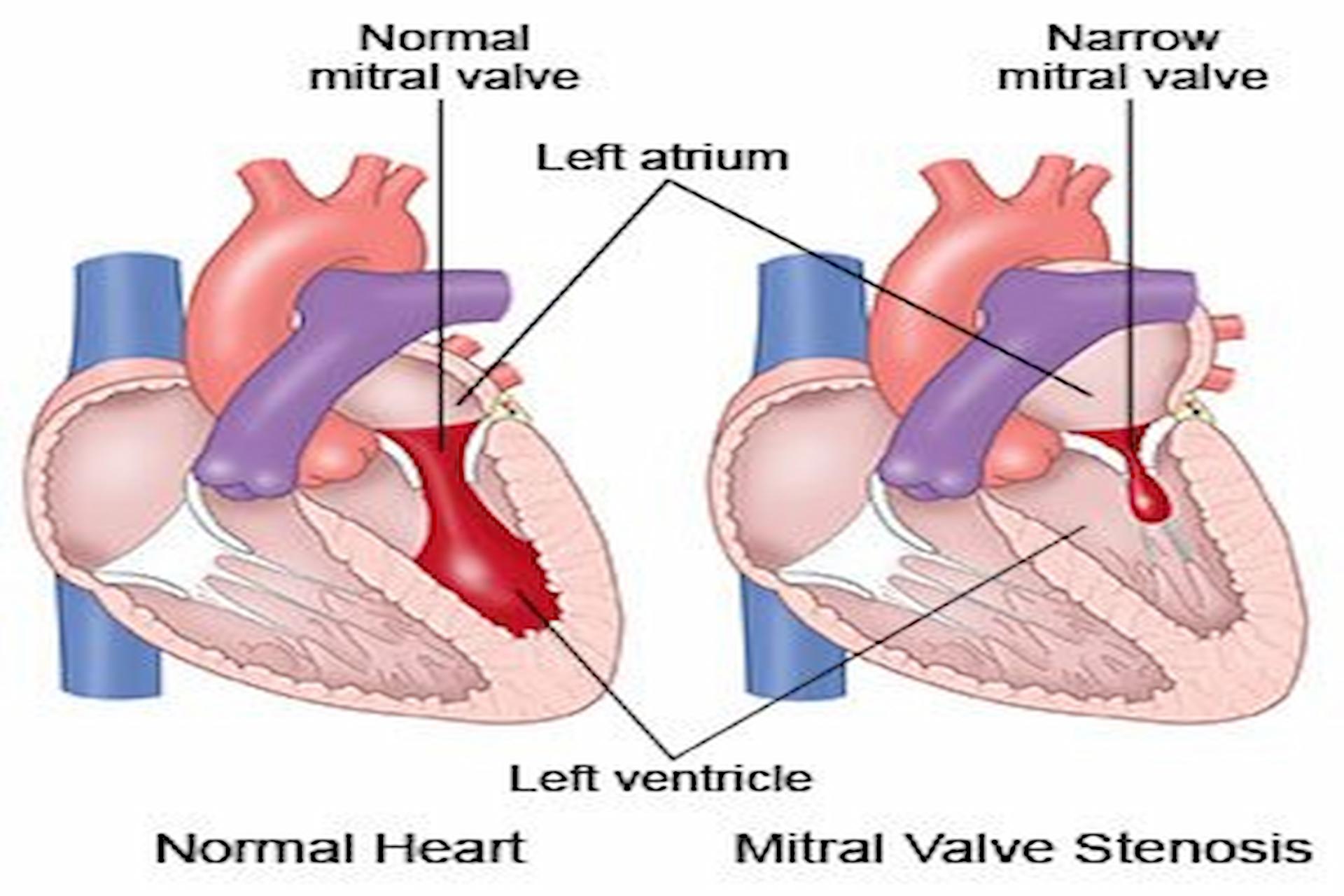 Why Being Overweight Massively Affects Your Hearts Health